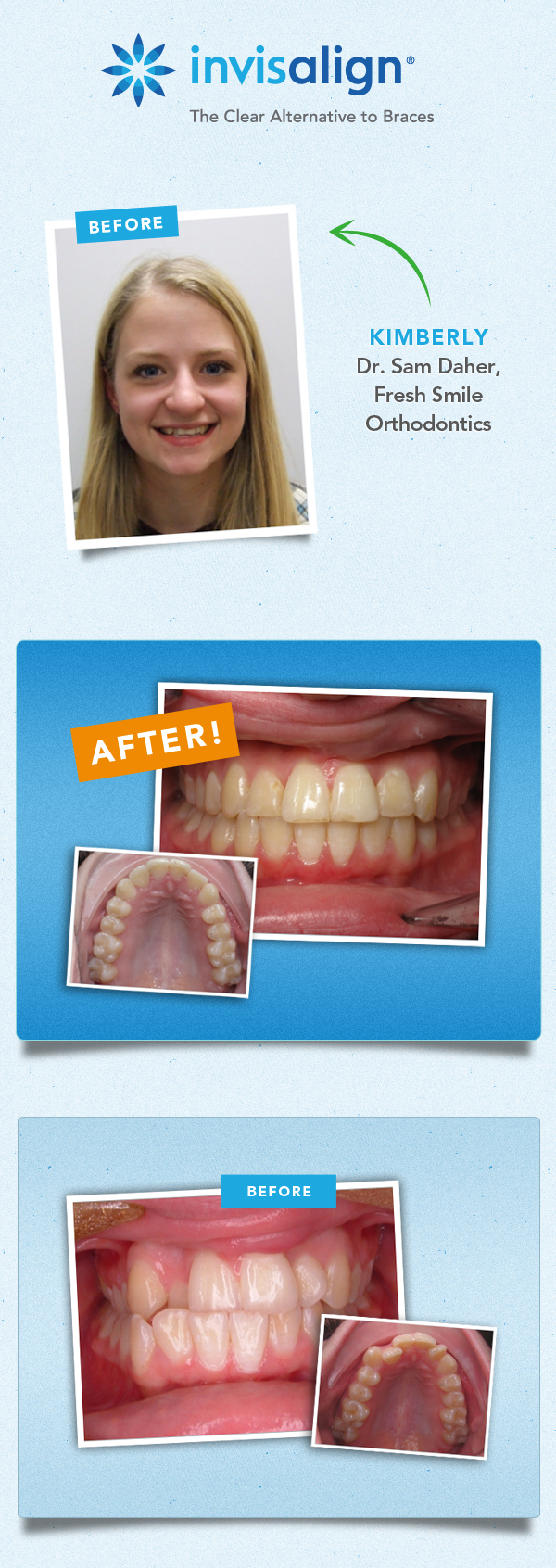 invisalign results fix crooked teeeth_kimberly