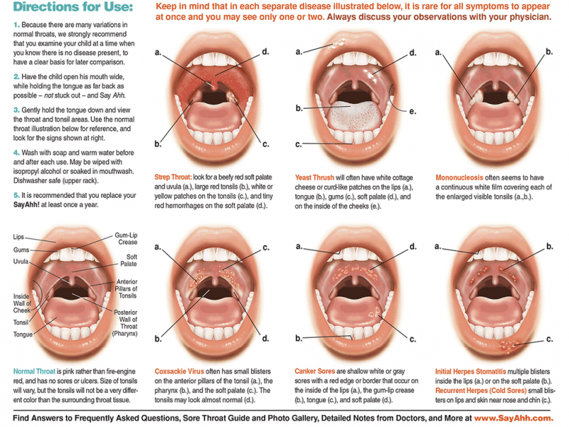 How Do I Know If My Child Has A Sore Throat